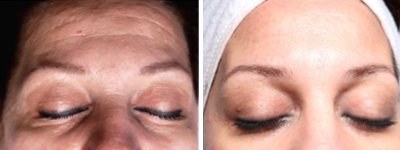 Soins JetPeel anti-âge