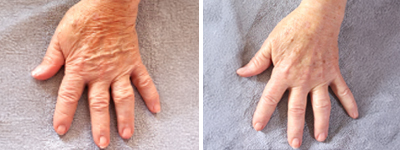 Traitement des mains