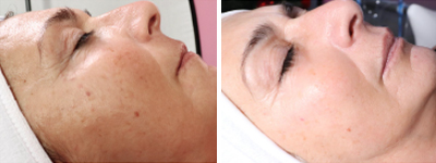 Amélioration du teint avec le JetPeel