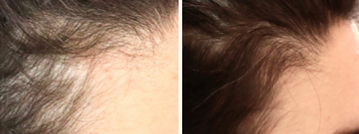 Uniformisation du teint avec le JetPeel