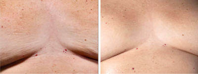 Traitement anti-âge JetPeel sur la poitrine