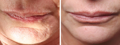 Traitement des rides