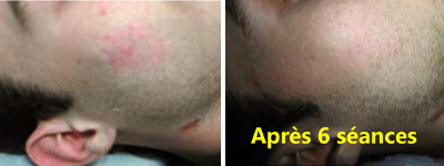 Réduction de séquelles d'acné avec le Rejulight XP