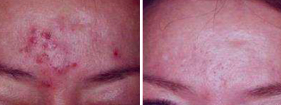 Réduction d'acné avec le Rejulight XP