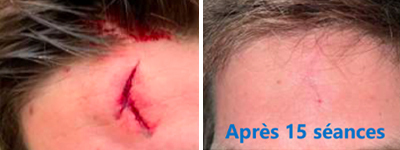 Réduction d'une cicatrice après 15 séances de Rejulight XP