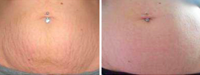 Réduction de vergeture avec le Rejulight XP