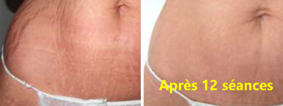 Réduction vergetures sur le ventre après 12 séances de Rejulight XP
