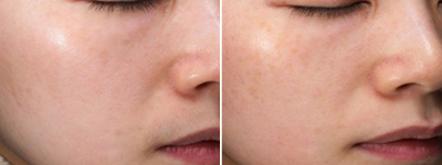 Imperfections cutanées