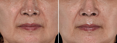 taches de vieillissement