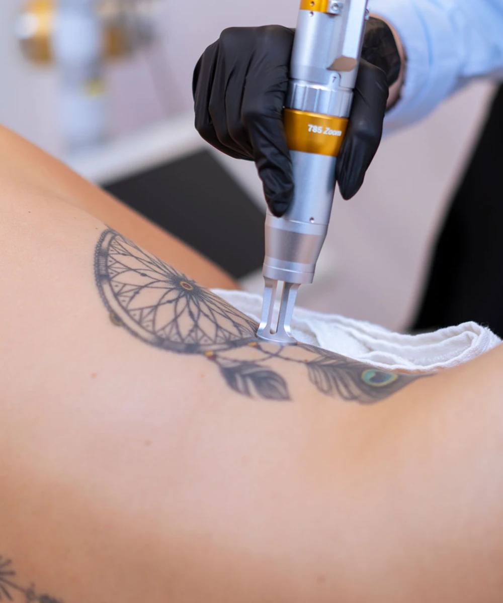 Détatouage Pico laser