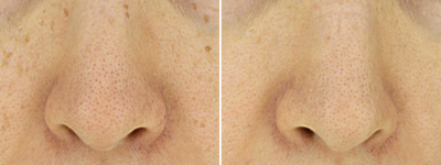 melasma