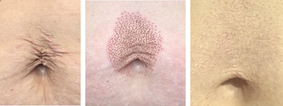 Avant-après Plasma