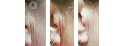 Avant-après Plasma